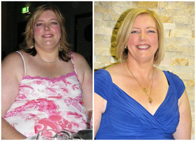 Jenny gastric sleeve before and after photo